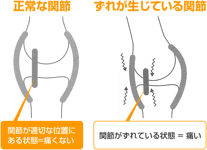 正常な関節とずれが生じている間接